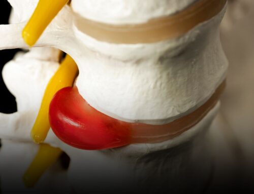 Hernia discal en la resonancia: por qué la imagen no siempre explica tu dolor