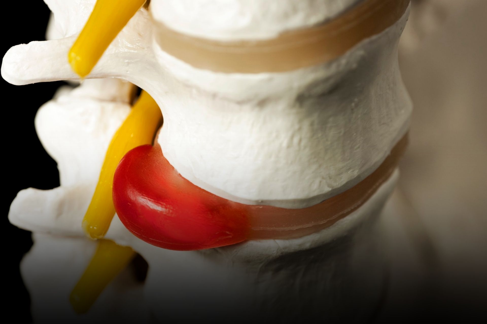 hernia discal